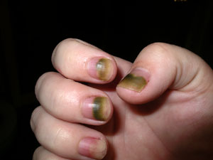Icky nails